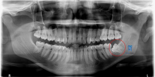 Dental-Surgery-Wisdom-Tooth-Extraction-2.jpg