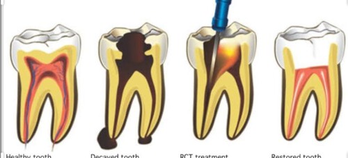 Your dentist has recommended that you see a periodontist, a dental specialist who treats periodontal disease. Periodontal disease is a bacterial infection..

Read More: https://mittaldentalclinic.com/gum-surgery/