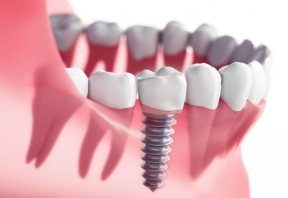 Implants-e1622535304267.jpg