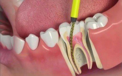 root-canal-treatments.jpg