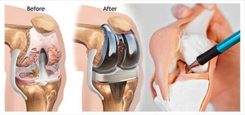 Avail the best service for knee replacement in Nagpur from Theayushmanhospital.com. It is a surgical technique that relieves pain and impairment by replacing the weight-bearing surfaces of the knee joint. For more info visit our site.


https://theayushmanhospital.com/specialties/joint-replacement/