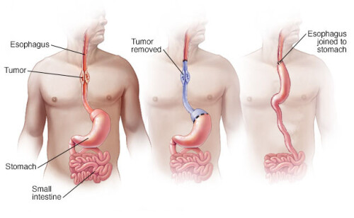 Dr. Sundeep Jain offers personalized esophageal cancer treatment in Jaipur with world class facilities. To Know more about esophageal surgery, contact us today!!

Read More:https://drsundeepjain.com/pancreatic-cancer-surgery/