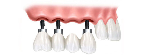 Mittal Dental Clinic Implant & Laser Centre in Nirman Nagar is one of the most preferred dental clinic in the Jaipur.

Read More: https://mittaldentalclinic.com/dental-implant/