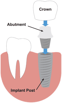 dental_implants.png