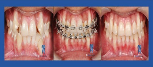 Braces-Bhopal-1024x264.jpg