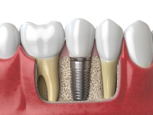 Dental-Implants.jpg