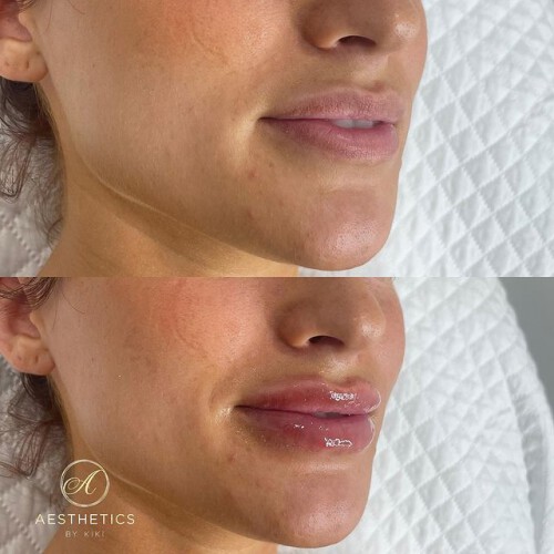 Aestheticsbykiki.com.au is a reputable website that provides the greatest service for PRP skin needling in Sydney. PRP is a highly sought-after non-surgical procedure for facial and skin rejuvenation. Feel free to contact us if you have any queries.

https://aestheticsbykiki.com.au/prp-skin-needling