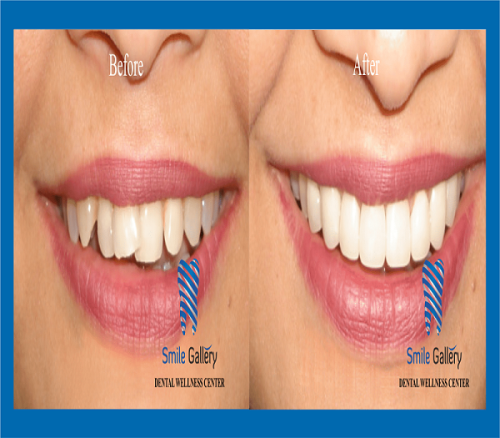 Searching for the best dentist for braces near me? Smile-gallery.com is a remarkable dental clinic in Bhopal that provides quality and ethical care to patients. We use Highly Sophisticated Machines and Technologies for the treatment. Keep in touch with us if you need more information.

https://smile-gallery.com/ironthm_service/orthodontic-dental-braces-treatment/