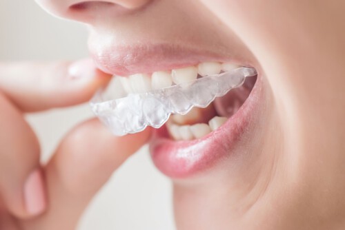 Searching for the best dentist for braces near me? Smile-gallery.com is a remarkable dental clinic in Bhopal that provides quality and ethical care to patients. We use Highly Sophisticated Machines and Technologies for the treatment. Keep in touch with us if you need more information.

https://smile-gallery.com/ironthm_service/orthodontic-dental-braces-treatment/