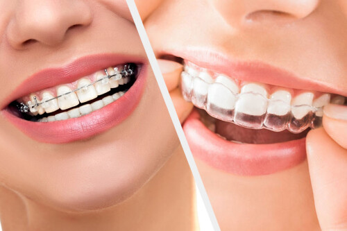 Looking to know about   Invisible Braces? then, look at sdalign.in ,for budget-friendly and high-quality braces. Visit our site for more queries.

https://sdalign.in/invisible-braces/