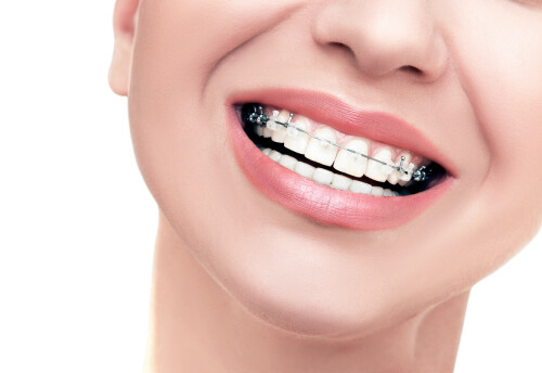 Adult Invisible Braces is good for those who want to install a good shinning brace in their teeth, visit at  sdalign.in, for such good adult braces therapy.

https://sdalign.in/invisible-braces/
