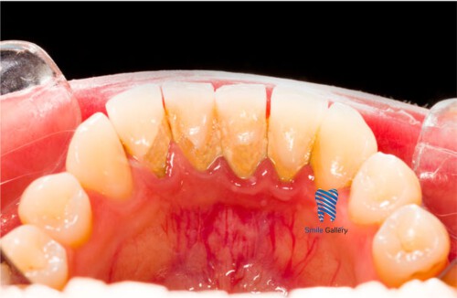 Searching for a reliable clinic to get the best teeth braces? Smile-gallery.com is the Best Dental Clinic in Bhopal. We have a full range of solutions to treat the problems of the teeth. Visit our website for more refined information.


https://smile-gallery.com/ironthm_service/orthodontic-dental-braces-treatment/