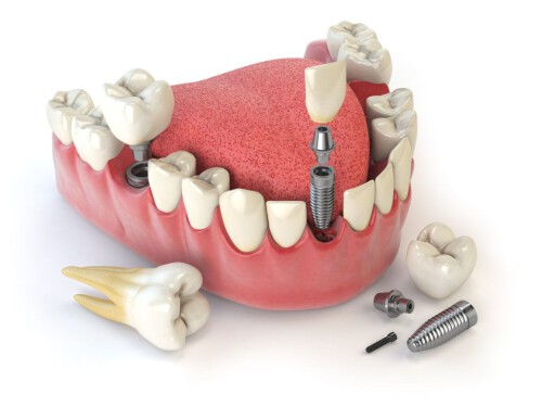 Looking for the best dentist in Bhopal? Smile-gallery.com is the most trustworthy platform for catering to all dental needs. We provide many dental treatments like dental implants, root canal treatments, gums and bone, orthodontic treatment, dental surgeries etc. at a very affordable price. For more relevant info, visit our site.


https://smile-gallery.com/
