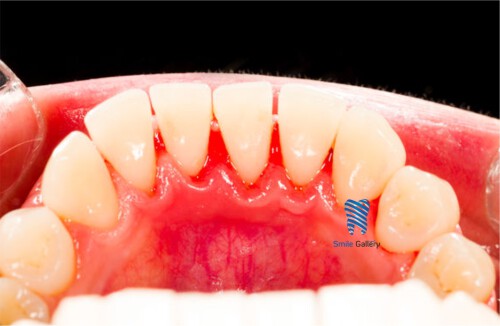 If you plan to get Braces, Smile-gallery.com is the best Braces specialist in Bhopal. Our Orthodontist caters to various mouth-related problems such as protruding teeth, speech problems, mouth breathing, etc. You can contact us immediately.



https://smile-gallery.com/ironthm_service/orthodontic-dental-braces-treatment/