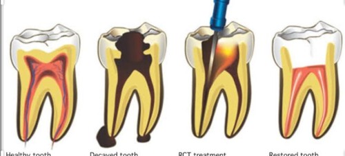 Mittal Dental Clinic Implant & Laser Centre in Nirman Nagar is one of the most preferred dental clinic in the Jaipur.

Read More: https://mittaldentalclinic.com/root-canals/