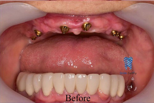 Want the dental implants in Bhopal? Smile-gallery.com is the most precise platform for the implants of teeth. We give the best and advanced method for all dental treatments, and here you receive the state of the art and budget services. Keep in touch with us for further details.

https://smile-gallery.com/ironthm_service/dental-implants/