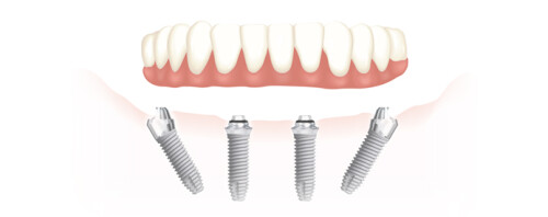 Basal-Implant.jpg