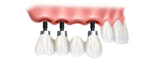 Basal-Implant-copy.jpg