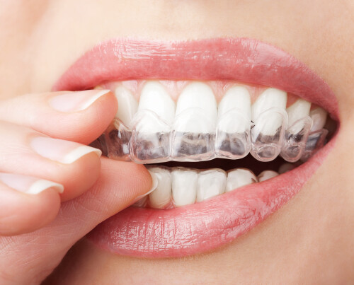 Teeth-Whitening-Clinic-Auckland.jpg