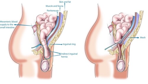 Dr Sundeep Jain is the qualified and award-winning hernia surgeon in Jaipur, India providing all types of hernia surgeries & treatments. Book your appointment today!

Read More: https://drsundeepjain.com/hernia-surgery/