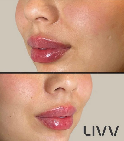 Microneedling-san-diego-cost.jpg