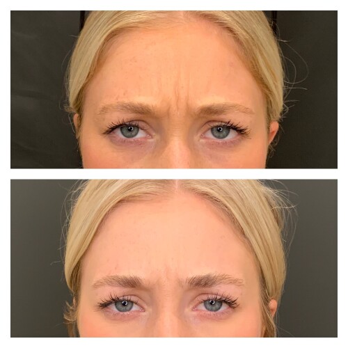 Botox_Nuceiva05-min.jpg