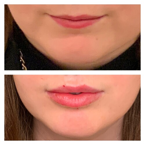 Lip_Filler05-min-2.jpg