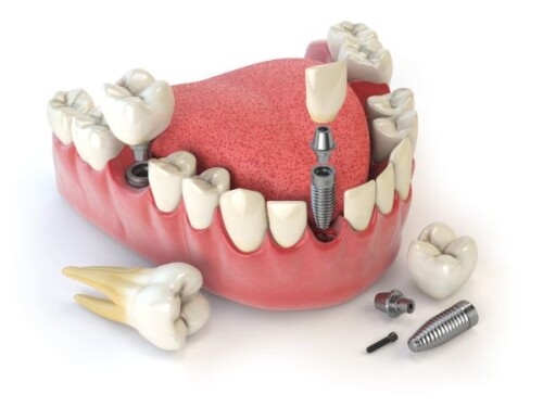 Looking for a dentist in Bhopal near me? Smile-gallery.com has covered you. We offer a wide range of dental services to meet your needs. Contact us today to schedule a consultation. Check out our site for more details.

https://smile-gallery.com/