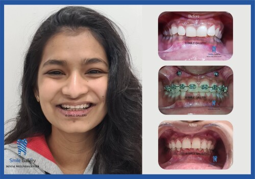 Searching for the dental doctor in Bhopal? Smile-gallery.com is a well-known place for all dental problems by the most innovative techniques. Discover all the more today; visit our site.

https://smile-gallery.com/