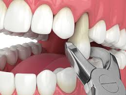 Best-Tooth-Extraction-Bradenton-In-Florida.jpg