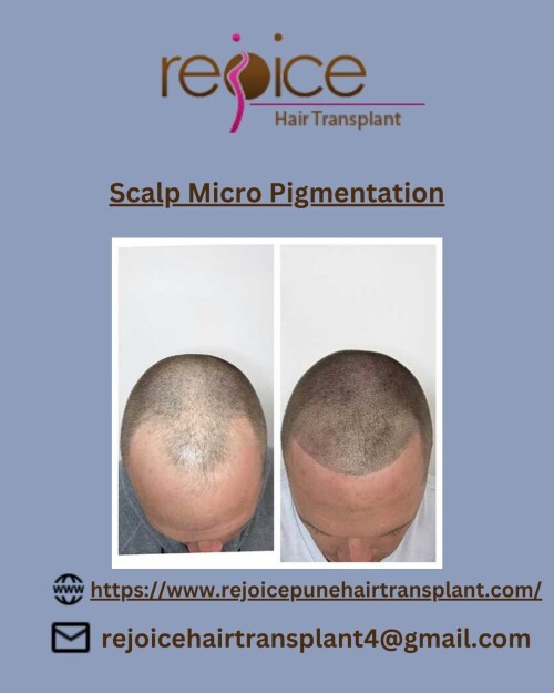 Scalp-Micro-Pigmentation.jpg