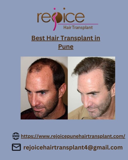Dr. Shankar Sawant, when he founded Rejoice™ had only one thing in mind.He wanted to provide world-class services of hair transplant in India. And since 2002, we’ve been helping people fight hair loss and baldness.Team Rejoice™ is one of the best hair transplant teams in India.Our experienced doctors led by Dr. Shankar Sawant are experts in their respective domains. They are humble and passionate about serving people. Rejoice gives Best Hair Transplant in Pune
View More at: https://www.rejoicepunehairtransplant.com/