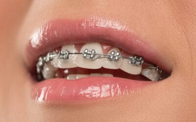 braces-london-400x250.jpg