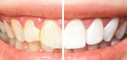 Teeth-Whitening-Lakewood-In-Ranch.jpg