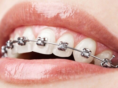 metal-braces.jpg