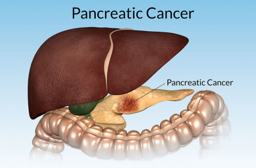 Pancreatic-Cancer-100-1024x6725fc429e81d73c3a6.jpg