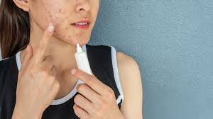 Best-Ingredients-to-Get-Rid-of-Fungal-Acne.jpg