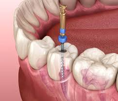 Root-Canal-Treatment-In-Morton-Grove-IL.jpg