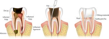 Root-Canal-Treatment-In-Morton-Grove-IL.jpg