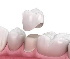 Best-Dental-Caps-In-Morton-Grove-IL.jpg