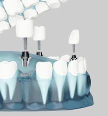 Tooth-Implants-Bradenton-Florida.jpg