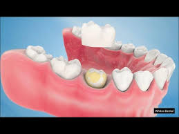 Best-Dental-Caps-In-Morton-Grove-IL.jpg