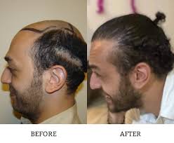 Best-Bosley-Hair-Transplant-Bost.jpg