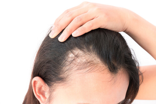 hair-loss-women.jpg