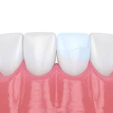 Dental-Bonding-Excellence-in-Chicago-IL.jpg