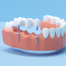 Best-Dental-Implants-In-Morton-Grove.jpg