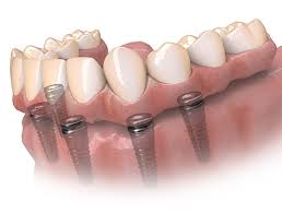 Hybridge-Dental-Implant-Solution-in-Greenbrier-TN.jpg