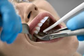 Tooth-Extraction-Lakewood-In-Ranch.jpg