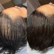Best-Scalp-Micropigmentation-For-Long-Hair.jpg