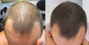 Best-Scalp-Micropigmentation-For-Long-Hair.jpg